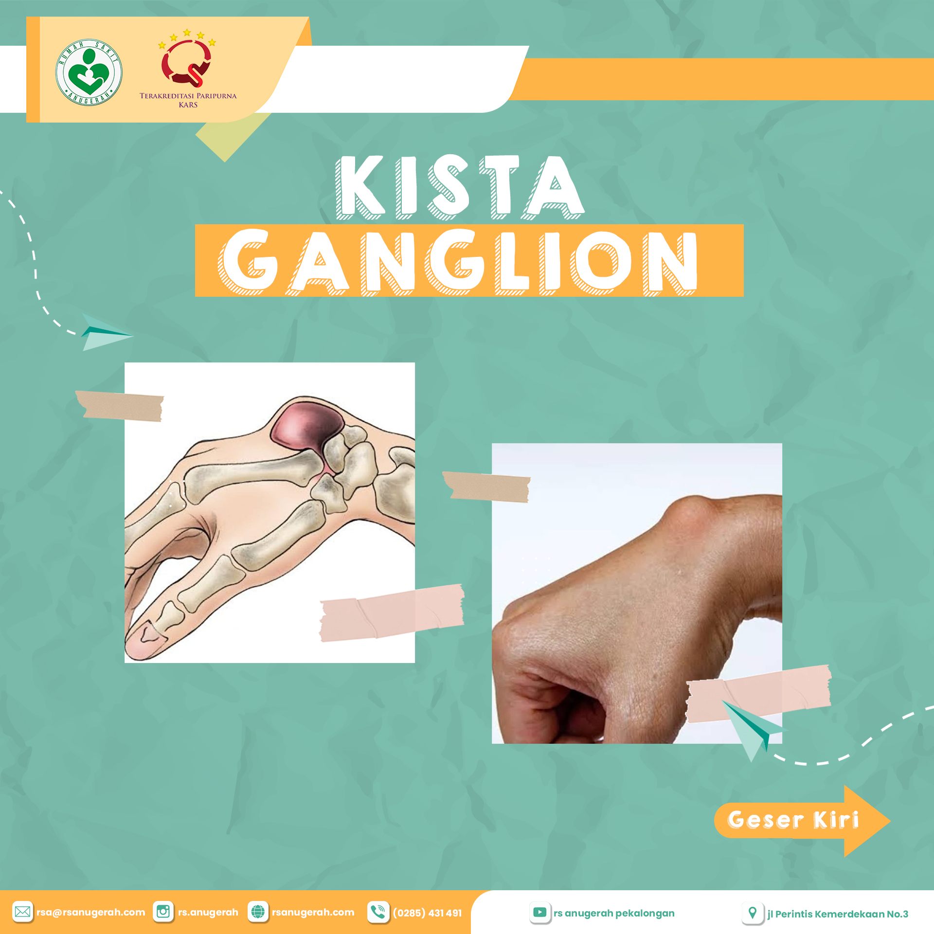 KISTA-GANGLION-slide-1